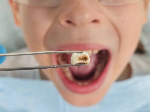 Best Broken or Chipped Tooth Repair in Unt Vernon, MO